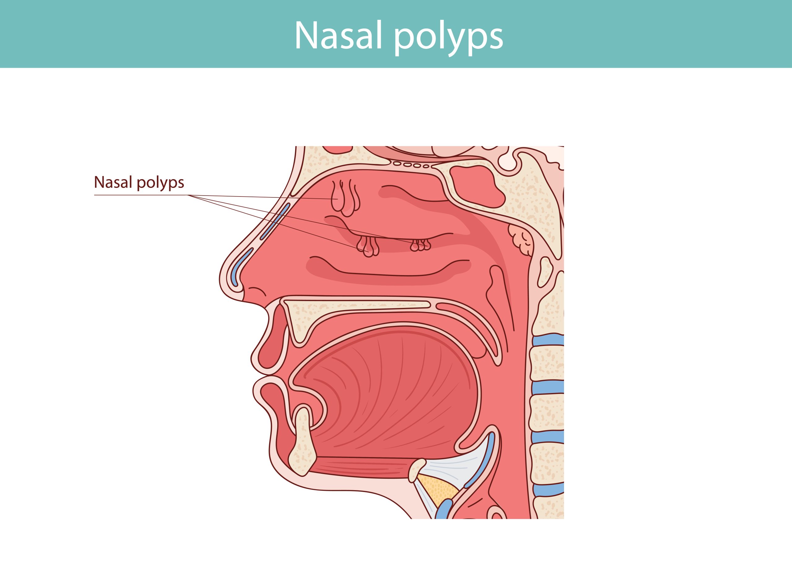 Nasal Polyps Diagram: Anatomy of the nasal cavity, sinuses, mouth, turbinates and polyps. Medical vector illustration