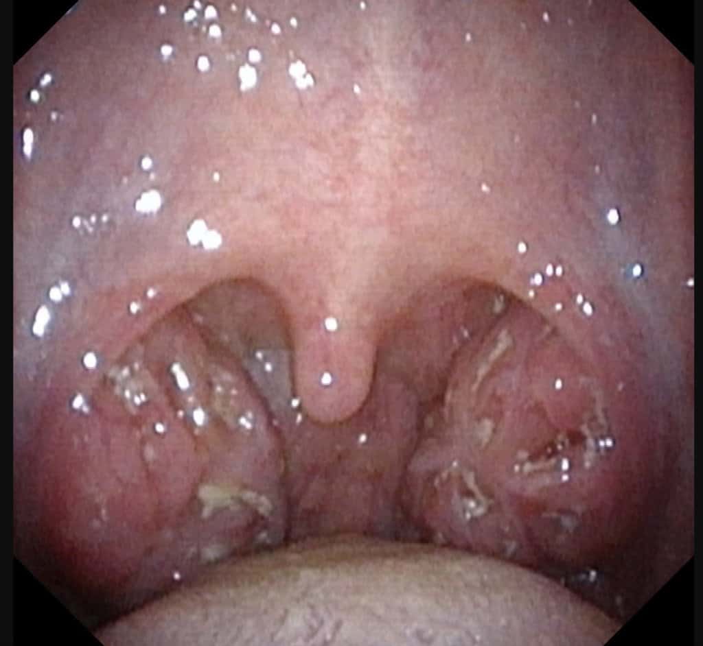 Acute tonsillitis