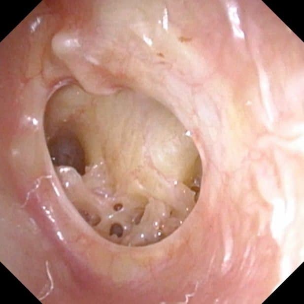 Hole in the ear drum