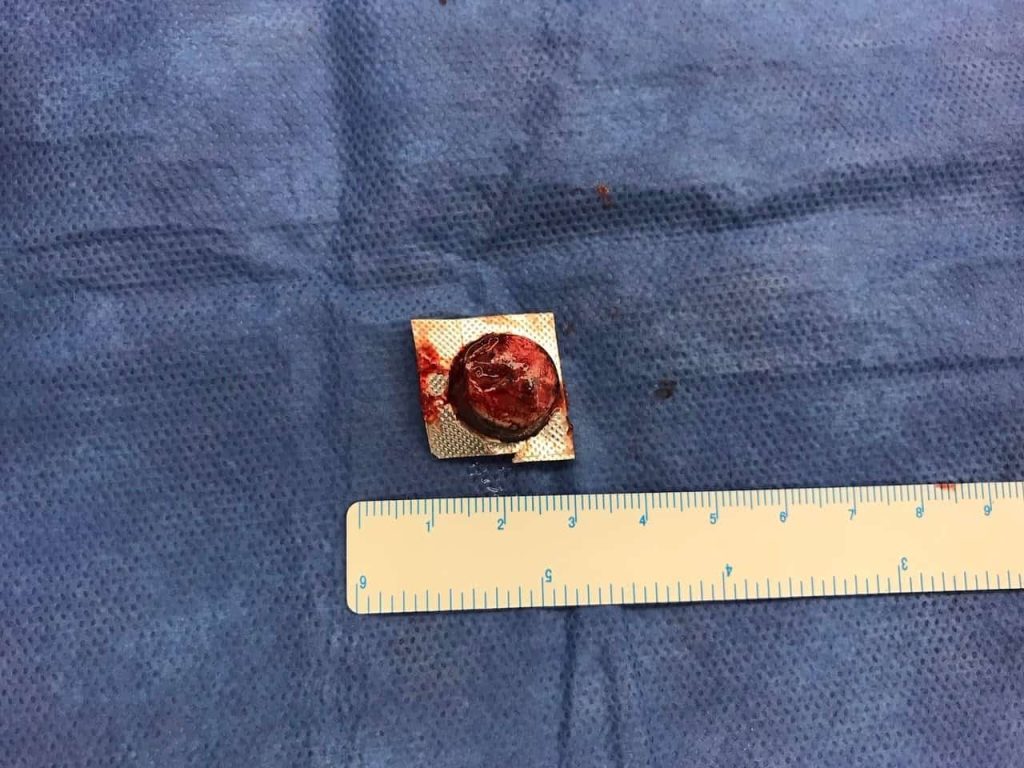 Pill box that was swallowed and was lodged in the esophagus.