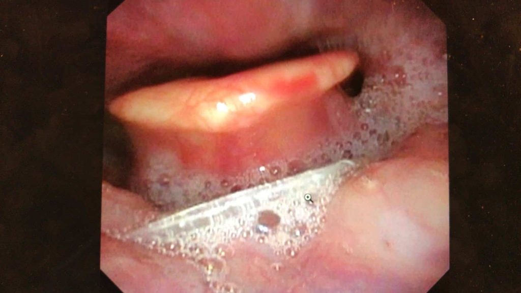Endoscope picture of a fishbone stuck deep down in the throat