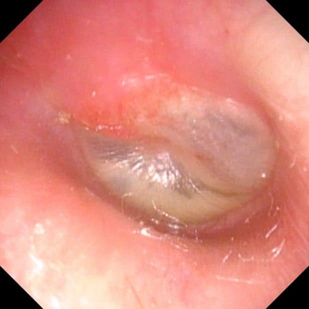 Middle ear infection