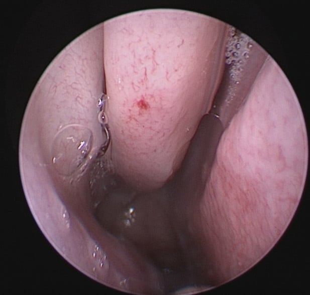 Epistaxis (Nose bleeds)