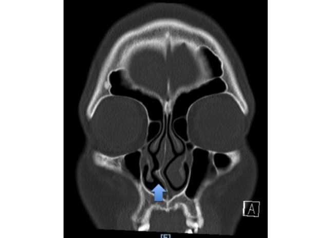 Deviated (Crooked) Nasal Septum
