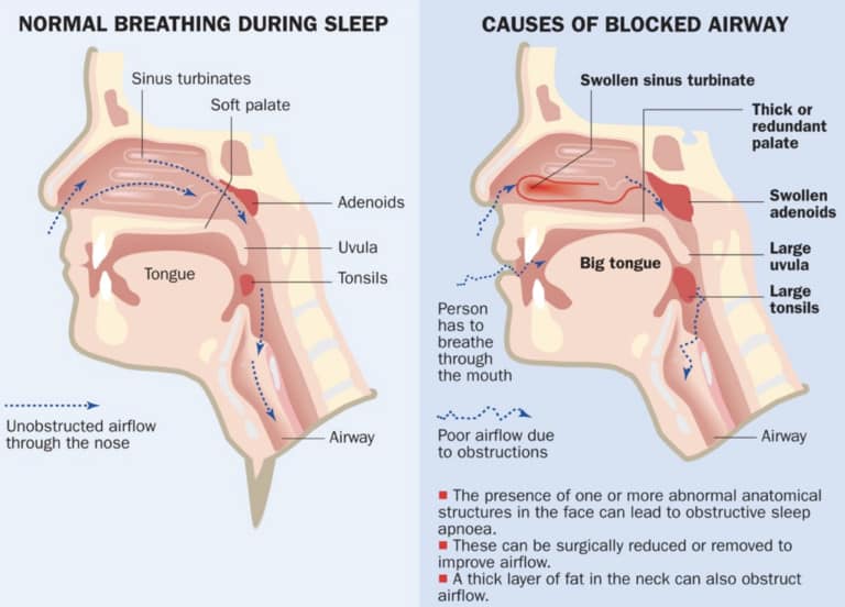 Causes of blocked airway