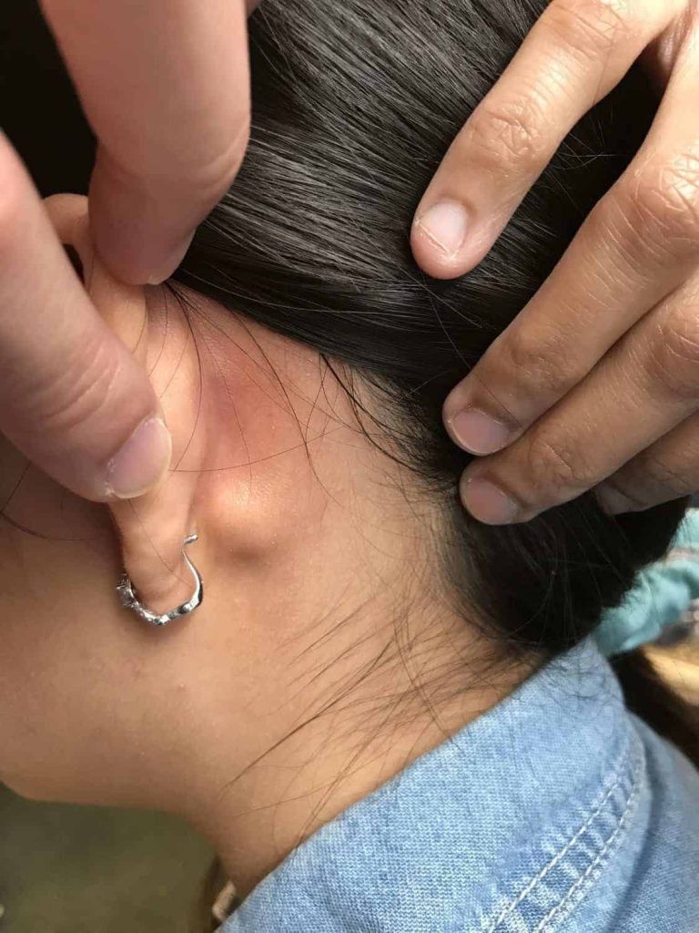 Left Parotid Postauricular Lump