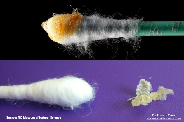 Comparison of Dry and Wet Earwax Removal