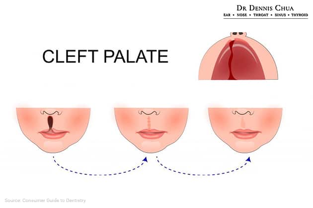 Cleft Rhinoplasty Can help Correct Cleft Lip and Palate