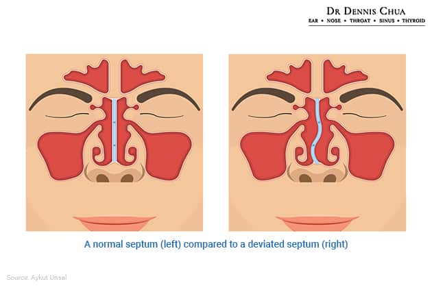 Rhinoplasty Can Help Correct Deviated Nasal Septum