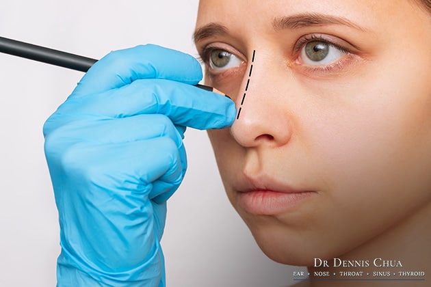 Benefits of Rhinoplasty