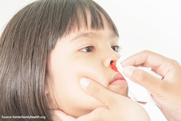 Nosebleeds paediatrics ent in Singapore