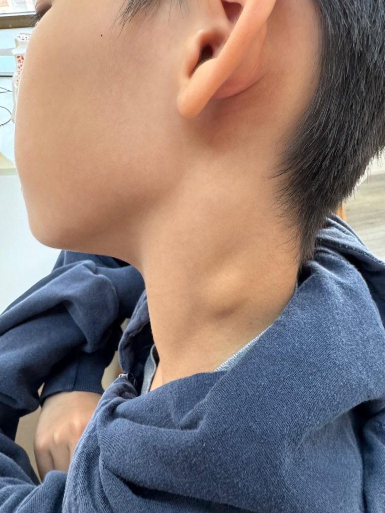 Close-up view of an ear, a bump on the neck, and shoulder