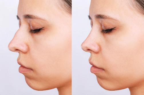 Side-by-side image of woman before and after rhinoplasty