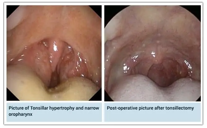 Side-by-side images showing tonsillar hypertrophy and a narrow oropharynx compared to a post-tonsillectomy