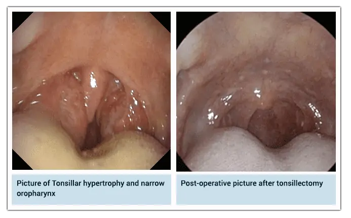 Side-by-side images showing tonsillar hypertrophy and a narrow oropharynx compared to a post-tonsillectomy