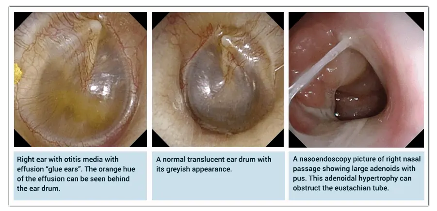 Three endoscopic images showing glue ears, normal eardrums, and nasal cavity with adenoids and pus