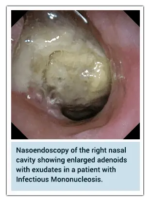 Nasoendoscopy image of the right nasal cavity revealing enlarged adenoids