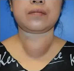 Close-up of a neck showing a bump