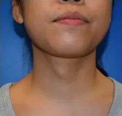 Close-up of a neck and chin area