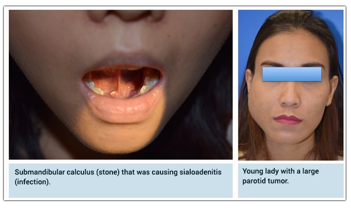 Open mouth revealing dental issues, noting the presence of a submandibular calculus causing sialoadenitis