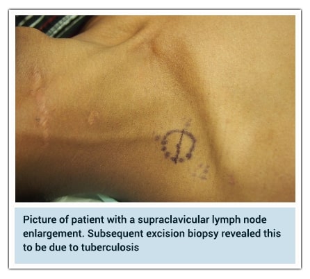 Neck of a patient showing marked enlarged supraclavicular lymph nodes
