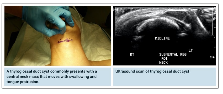 Image showing patient with a visible neck incision from a thyroglossal duct cyst removal, and an ultrasound scan