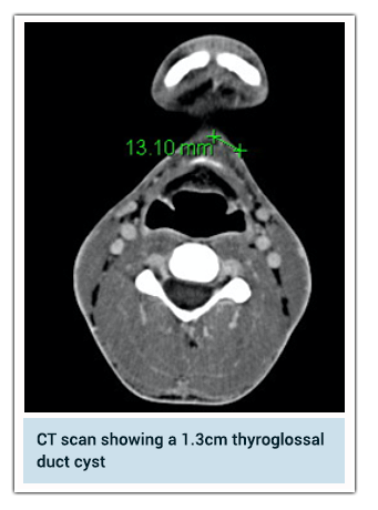 CT scan showing a 1.3 cm thyroglossal duct cyst in the neck region, with measurement annotation highlighted