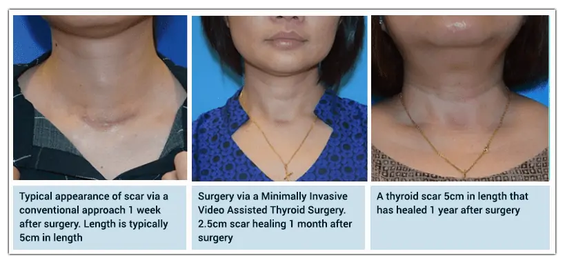 Thyroid Scars after surgery in an ENT clinic