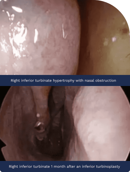 Nasal images showing right inferior turbinate hypertrophy with obstruction and post-turboplasty status