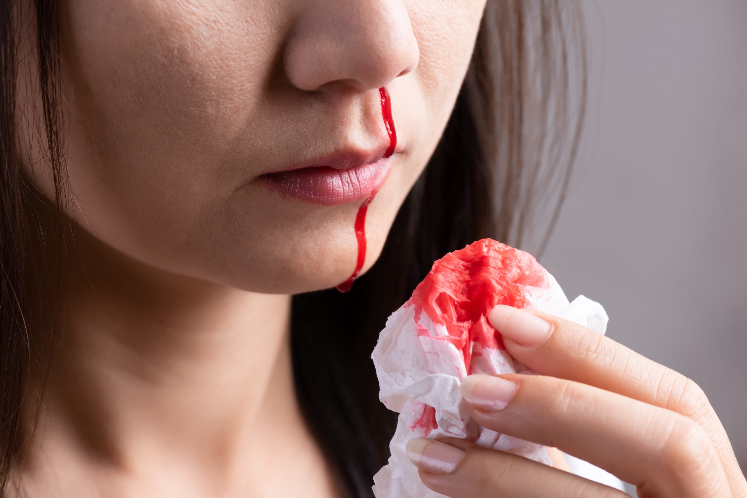 Nosebleed , a young woman suffering from nose bleeding and using